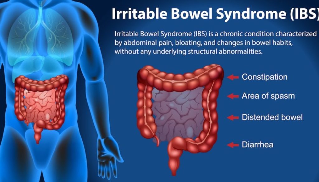 Irritable Bowel Syndrome (IBS) Infographic