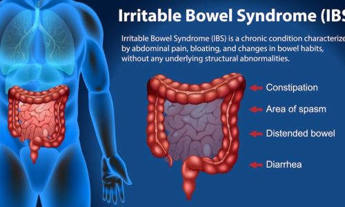 Irritable Bowel Syndrome (IBS) Infographic