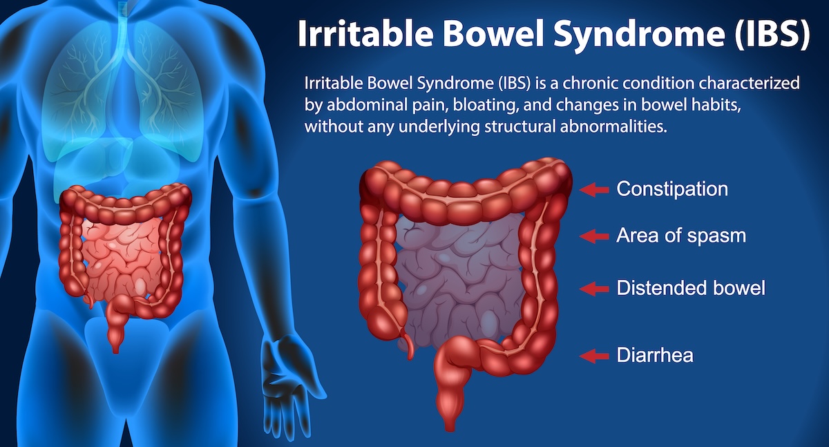 Irritable Bowel Syndrome (IBS) Infographic